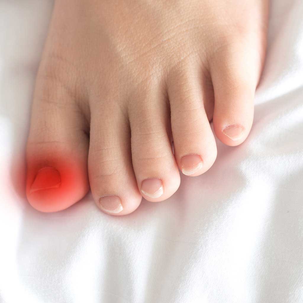 Ingrown toenails - Symptoms & causes - Mayo Clinic